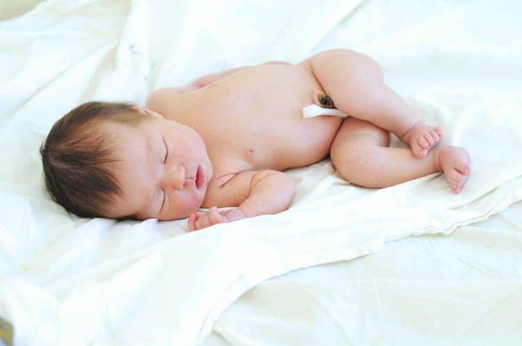 Пупкова грижа у новонароджених: причини і лікування
