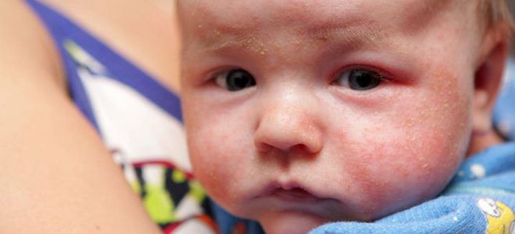 Температура при алергії у дітей: буває
