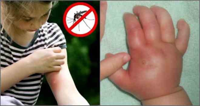 Алергія на укусу комарів: симптоми і виявлення
