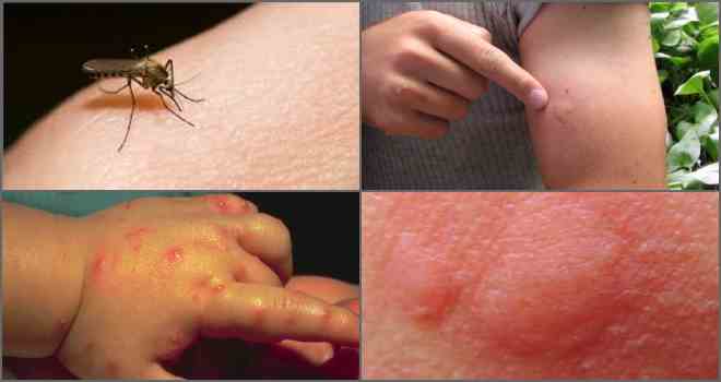 Алергія на укусу комарів: симптоми і виявлення