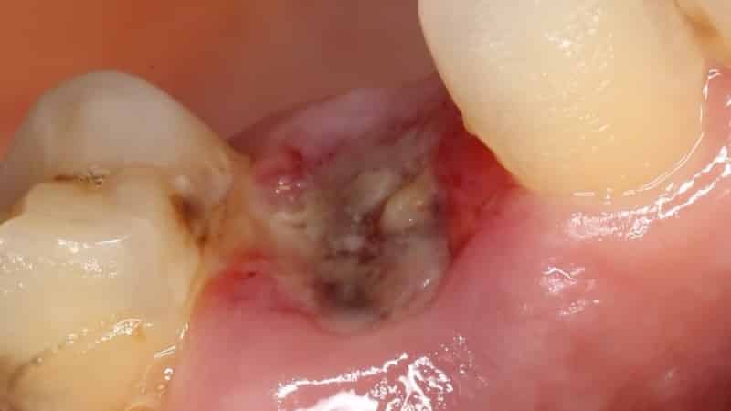 Чим полоскати рот, щоб швидко загоїти рану після видалення зуба