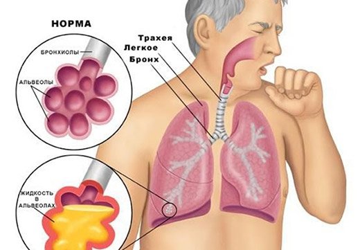 Інтоксикаційний синдром при пневмонії: симптоми та методи усунення