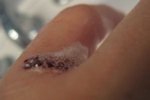 Як зупинити кров при порізі пальця і не допустити інфікування рани