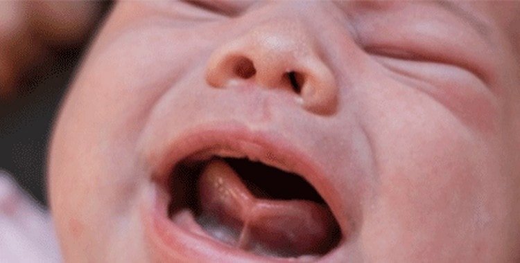 Коротка вуздечка під язиком у новонародженого: що робити