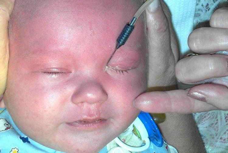 Масаж слізного каналу у новонароджених дітей