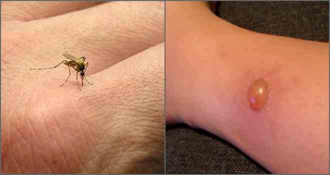 Наскільки небезпечний укус комара: корисні поради