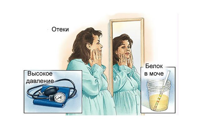 Невідкладна допомога при еклампсії – алгоритм дій і необхідна терапія