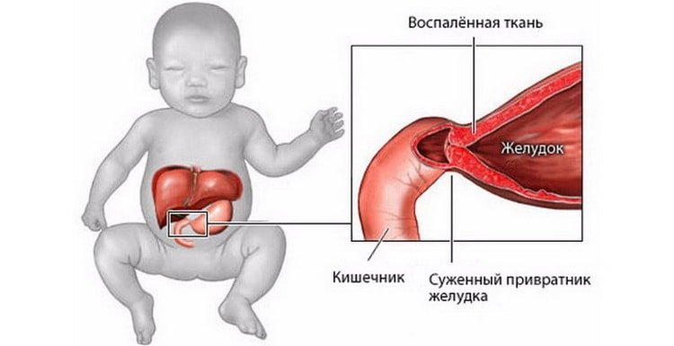 Пілоростеноз у новонароджених