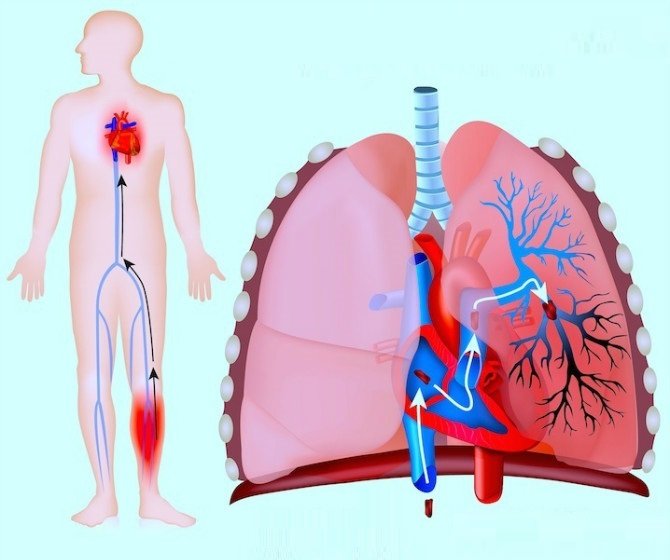 Симптоми тромбоемболії легеневої артерії та перша допомога при ТЕЛА