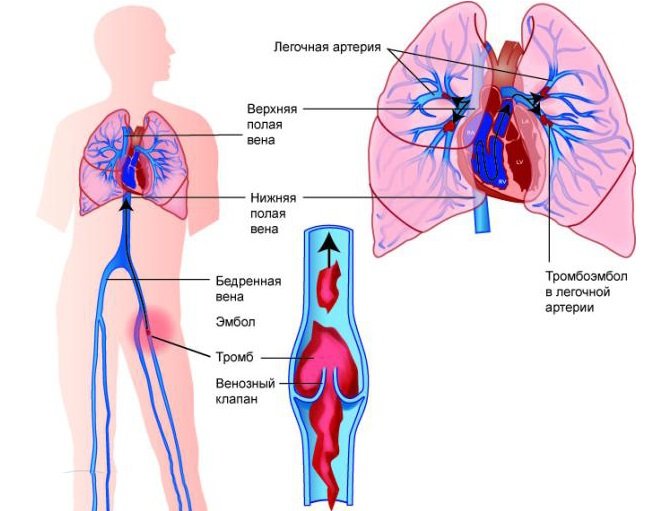 Симптоми тромбоемболії легеневої артерії та перша допомога при ТЕЛА