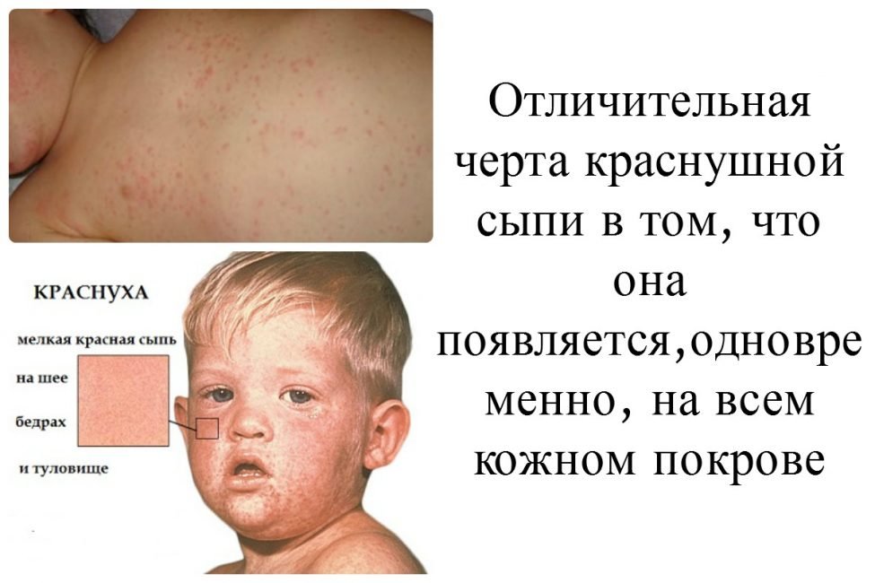 Висип на тілі у дітей: дрібна червона висипка, без температури, з температурою, з сверблячкою + 90 ФОТО
