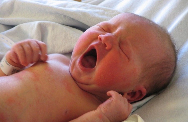 Токсична еритема новонароджених: симптоми і лікування