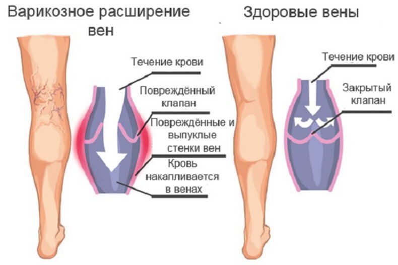 Варикозне розширення вен на ногах: причини, симптоми, лікування + ТОП 5 кращих способів позбутися варикозу
