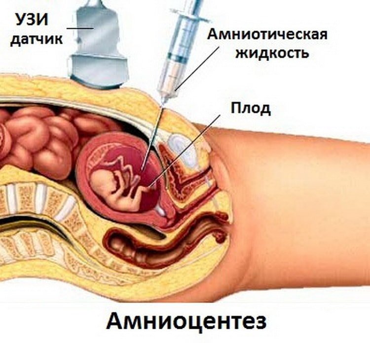 Амніоцентез при вагітності: коли призначають, протипоказання