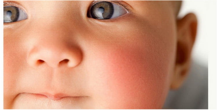 Діатез у немовлят: як виглядає, лікування
