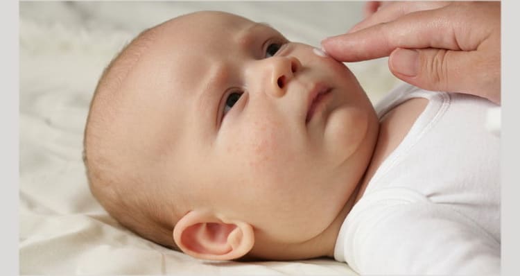 Діатез у немовлят: як виглядає, лікування