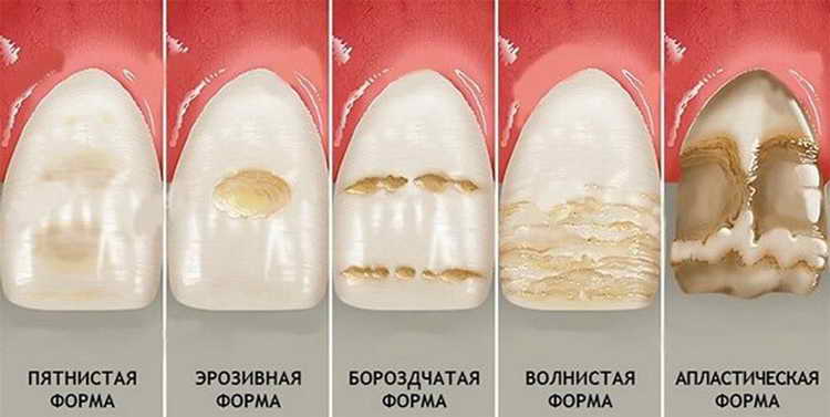 Фторування зубів у дітей: показання, відгуки