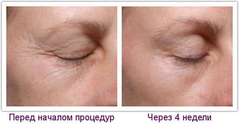Маски для шкіри навколо очей після 40 років в домашніх умовах
