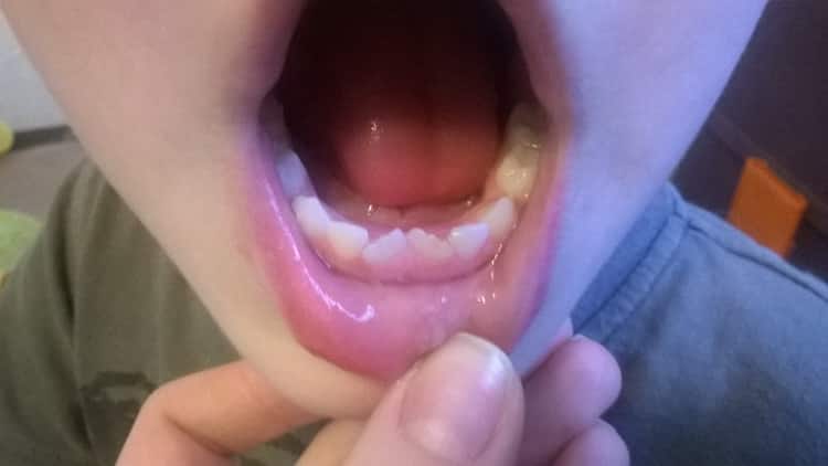 Чому криві зуби у дітей: молочні і корінні, фото