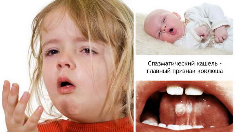 Сильний кашель у дитини: чим лікувати