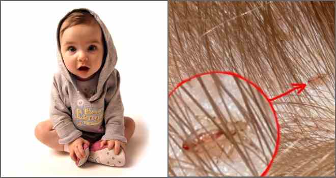 Воші у дітей: як лікувати і звідки беруться паразити