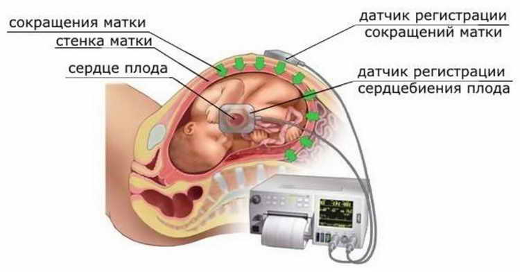 КТГ (кардіотокографія) при вагітності